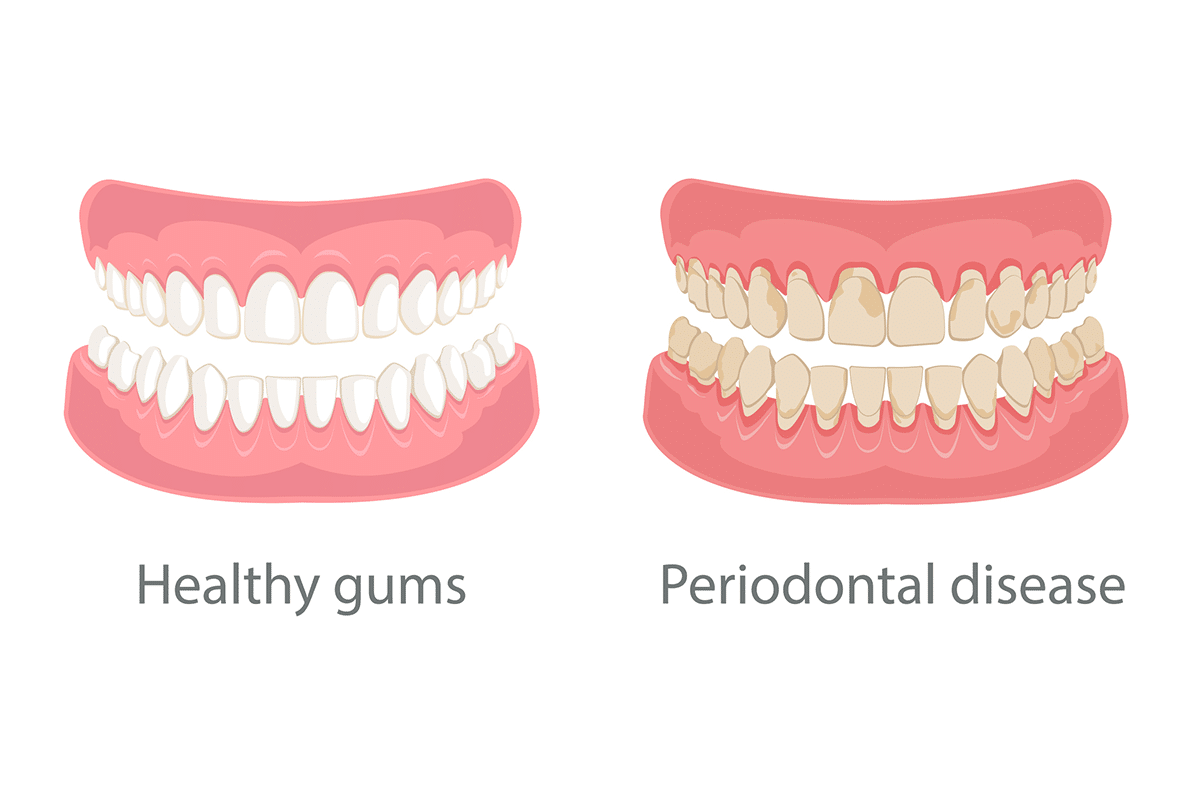 How Could Advanced Stages Of Periodontal Disease Affect Other Areas Of Your Life